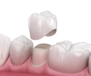 Dental crowns Chatham NC