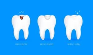 Composite Tooth Colored Fillings Chatham