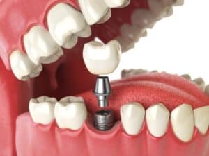 Implant dentist chatham