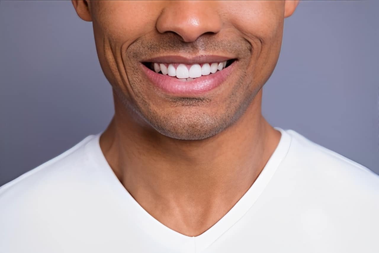 1739216110 veneers 1 (1)