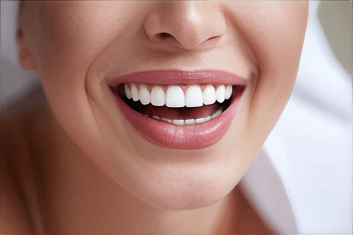 1739216113 porcelain veneers 1 (1)